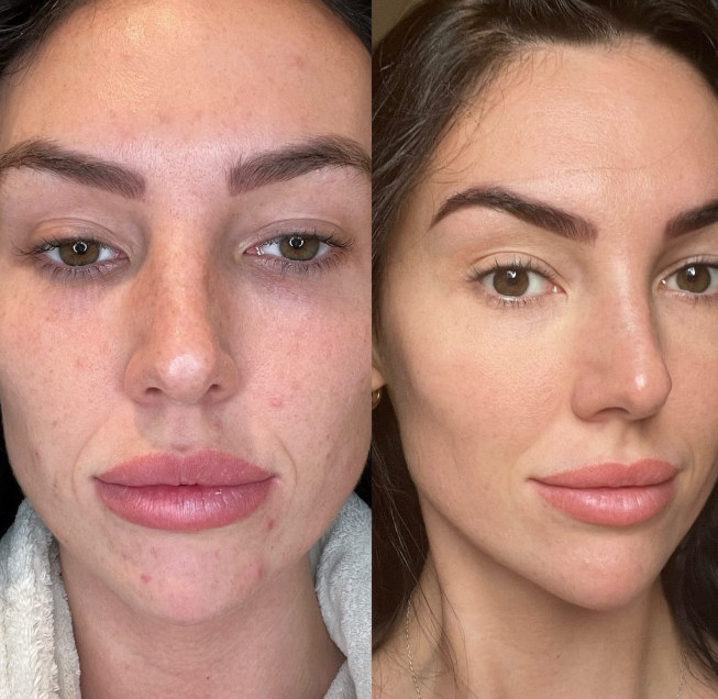 Before and after using Dr. Naomi skincare products — Walk of Shine cleanser, Let it B, Plump Fiction, Catfish, Swipe Bright Oil, and One Night Stand Mask.